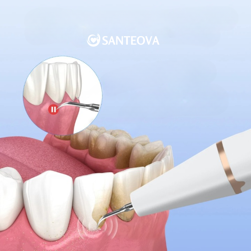 Dentapulse™ – Détartreur Dentaire Ultrason pour Plaque & Tartre à Domicile